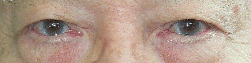 older Chinese gentleman with a distinct Type 1 Medial canthal configuration