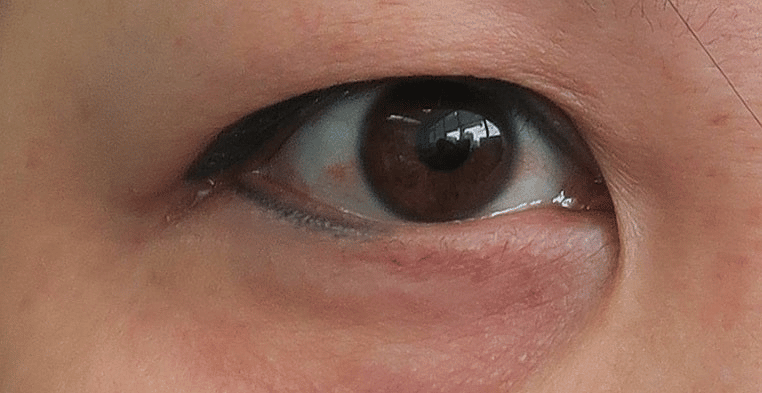 strong epicanthic fold extending downwards