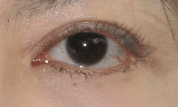 A surgically created Type 1 Open Medial canthus